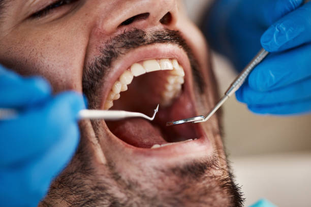 Best Emergency Dentist for Lost Fillings or Crowns in Maitland, FL
