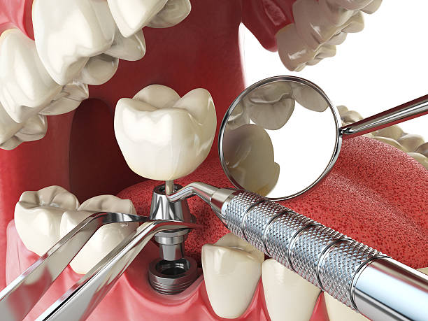 Best Emergency Dental Care for Abscessed Tooth in Maitland, FL